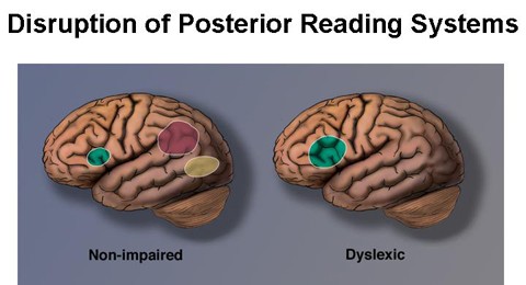 Dyslexia Dyslexia Test